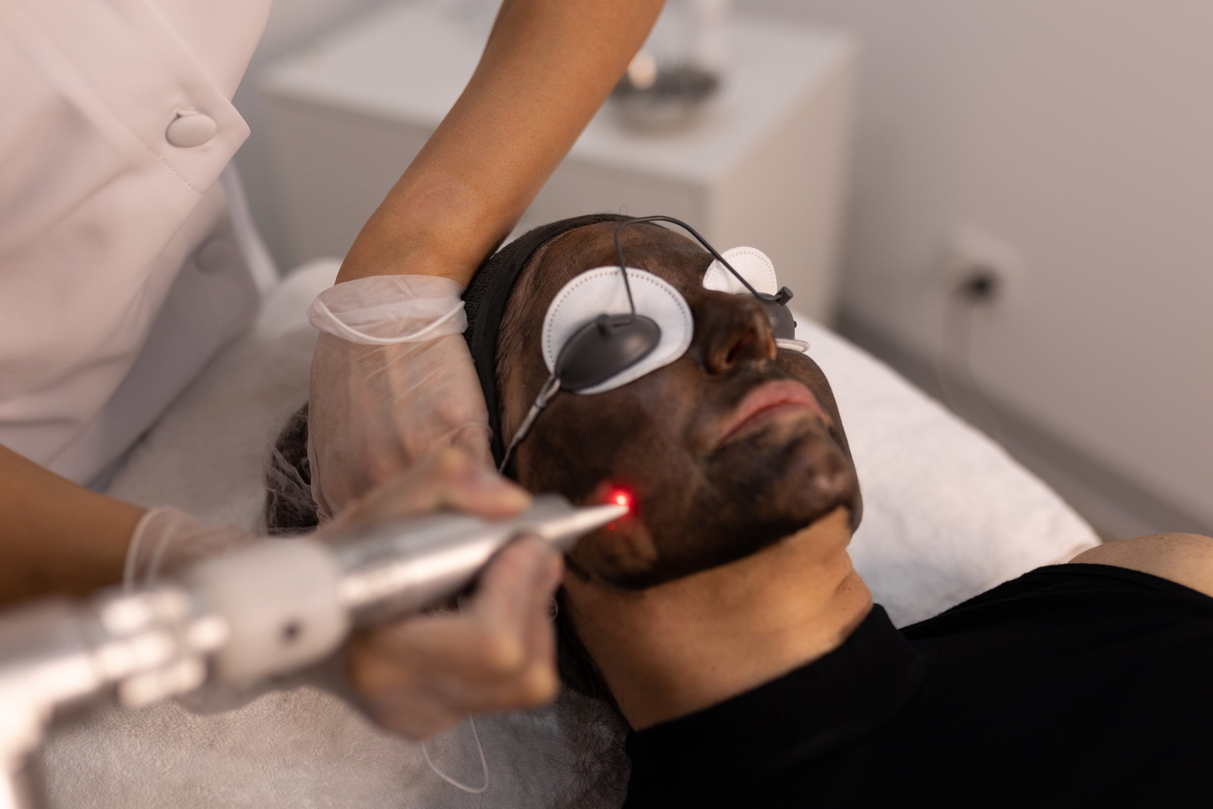 CARBON LASER FACIAL