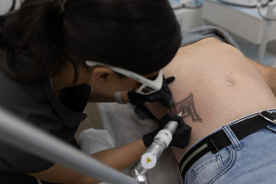 LASER TATOO REMOVAL